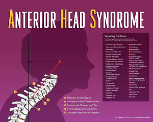 Chiropractic-Eureka-MO-Anterior-Head-Syndrome Chiropractic Eureka MO Anterior Head Syndrome